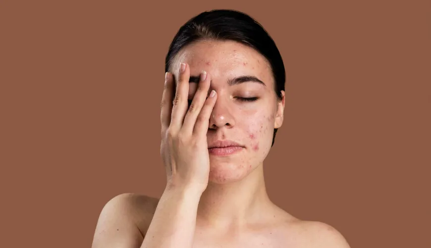 Como se livrar de nódulos subcutâneos dolorosos causados pela acne