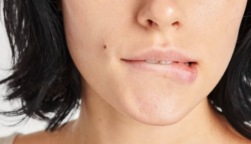 Causas da acne no queixo e como eliminá-la permanentemente