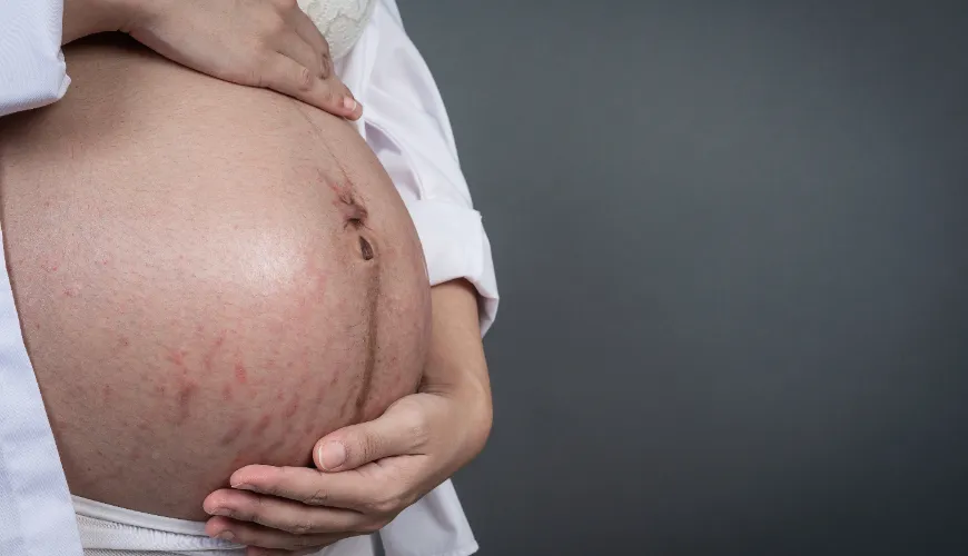 Maneiras naturais de combater a acne durante a gravidez